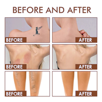 Before and after coverage of a tattoo, a birthmark and leg veins using NUELLE Body Perfector